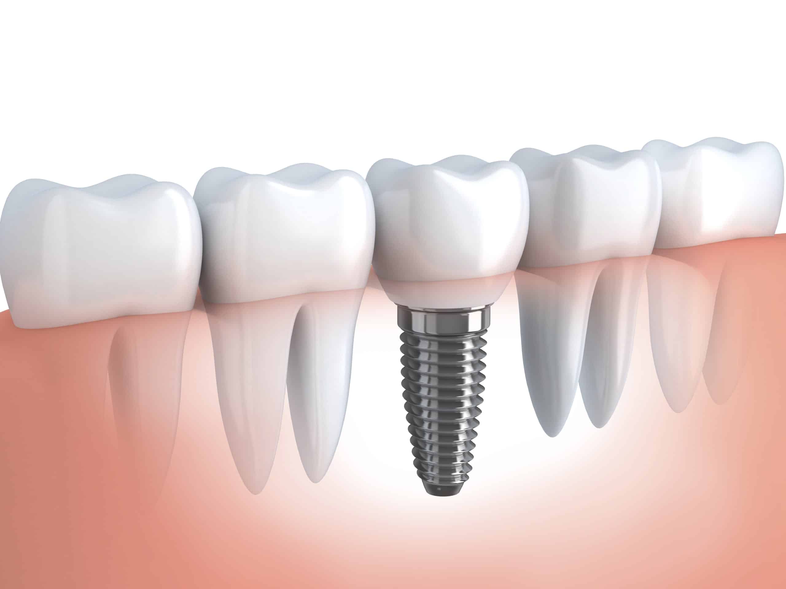 Dental Implant Dublin