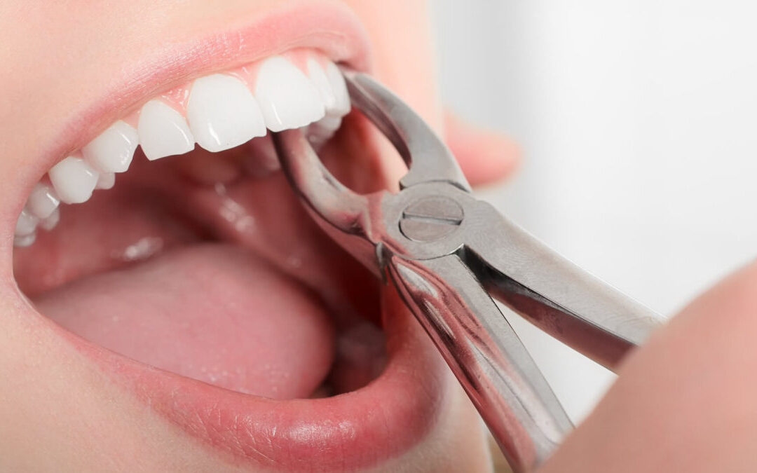 Dentures Procedures & Tooth Extraction