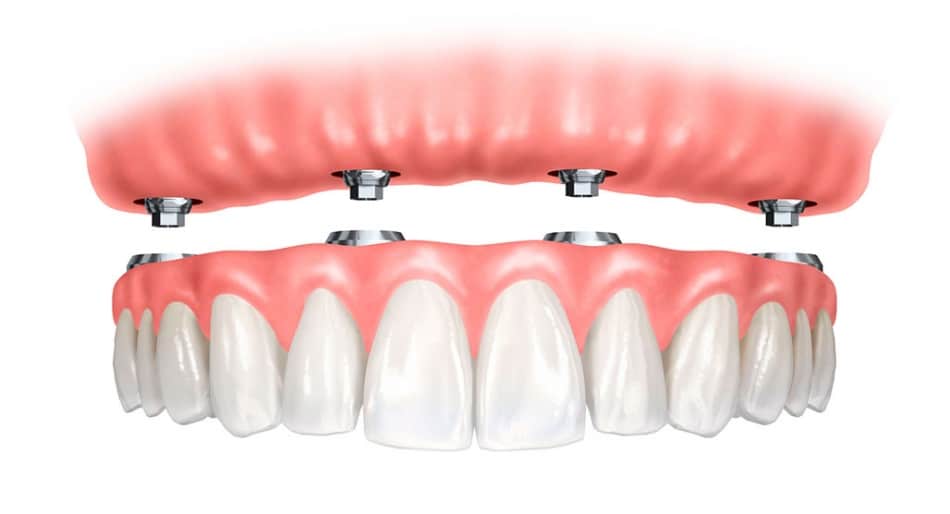 Are Dental Implant retained Dentures for me?