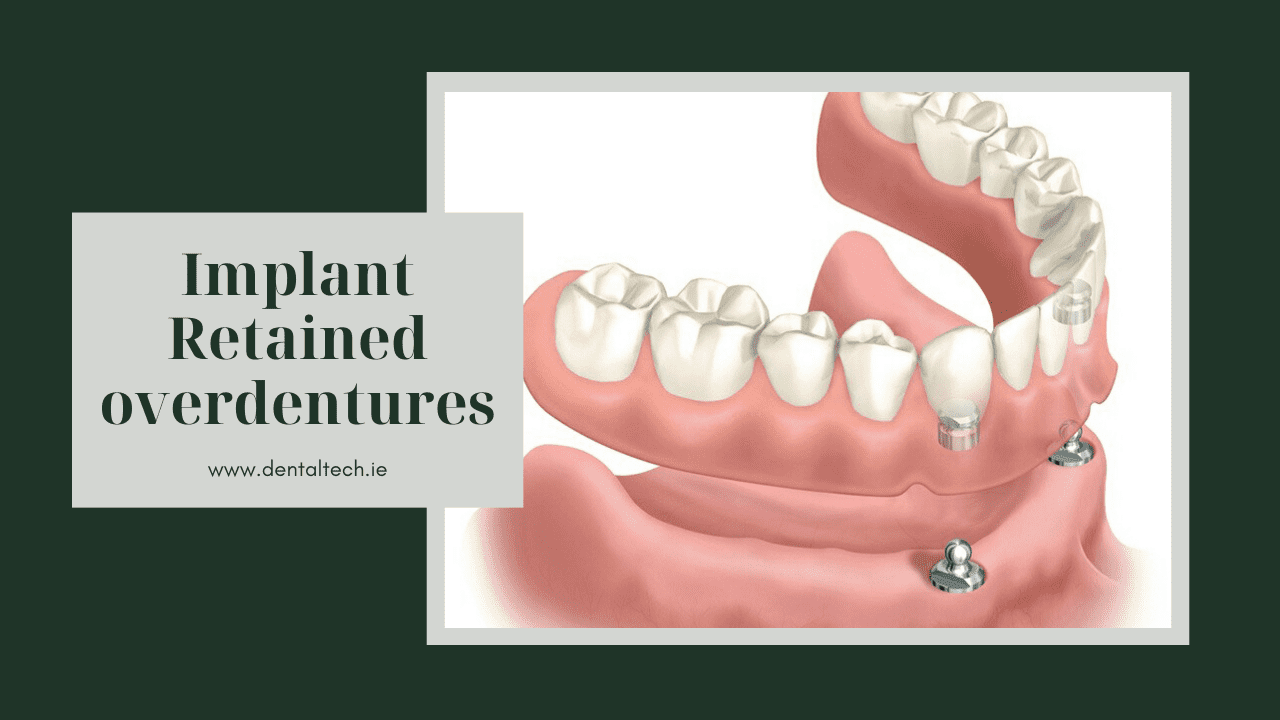 Implant retained overdentures