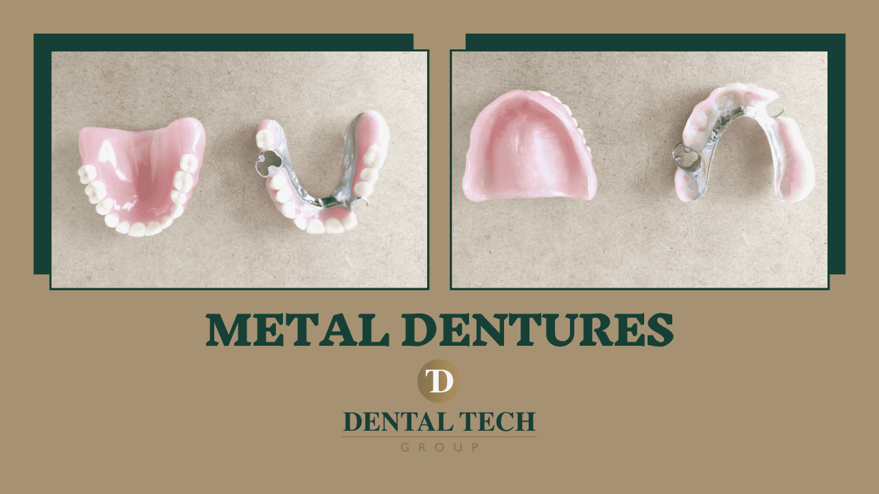 Metal Dentures