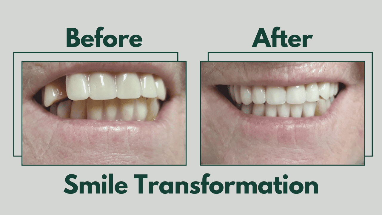 Smile Transformation