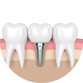 Dental Implant Process