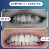 Compassing Bonding Composite Bonding Dublin