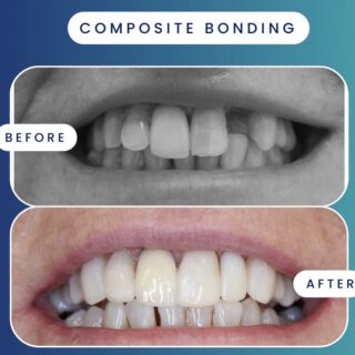 https://dentaltech.ie/wp-content/uploads/2025/03/CompositeBondingBA1-320x320.jpeg