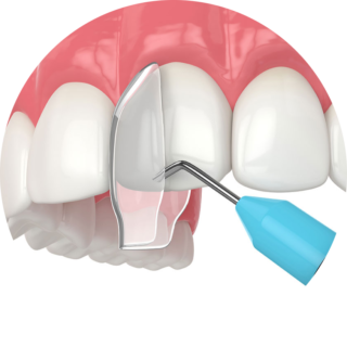 https://dentaltech.ie/wp-content/uploads/2025/03/CompositeBondingHow-320x320.png